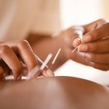Acupuncture now available at West End!